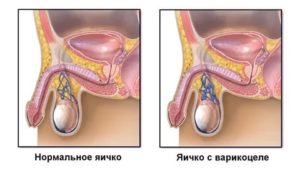 Левое яичко чувствительнее правого,  что это?