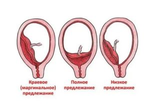 Опасно ли полное предлежание хориона на 13 недели беременности?