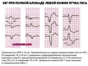 Информативно ли ЭКГ при плаче?