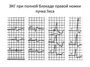 Плановое ЭКГ при ОРВИ