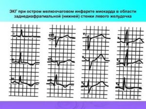 Информативно ли ЭКГ при плаче?