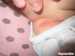Покраснение на половых губах у ребенка