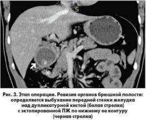 Эктопия поджелудочной железы