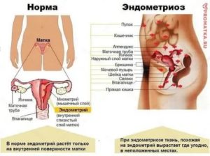 Нормально ли, когда после первого полового акта тянет в левом боку?