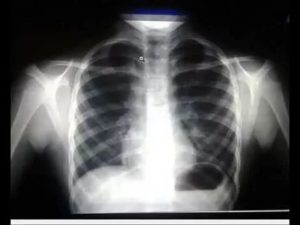 Объясните результат рентгенографии легких