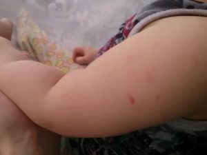 Высыпание на коже после прививки от гриппа