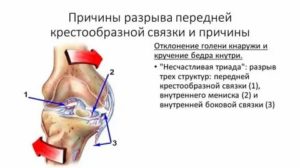 Что такое интралигаментрные повреждения ПКС?