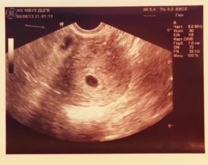 Шестая акушерская неделя, на УЗИ не видно эмбрион