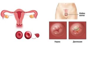 Как себя вести после конизации шейки матки?