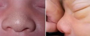 Черные точки на носу у ребенка