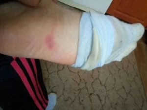 Красное болезненное пятно на ноге