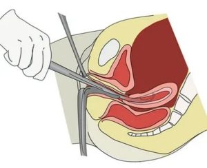 Боли в животе после выскабливания