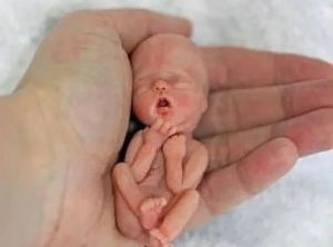 Аборт на 13-й неделе беременности