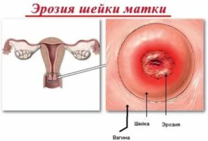 Можно заниматься сексом при эрозии?