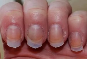 Дополнение к вопросу о пузырьках под ногтями после гель-лака