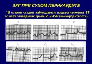 Информативно ли ЭКГ при плаче?