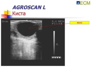 Уменьшение кисты или погрешность УЗИ?