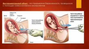 Может ли осмотр у гинеколога спровоцировать выкидыш?