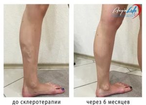 Можно ли заниматься спортом после удаления вен на обеих ногах?