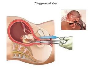 Может ли чистка после выкидыша стать причиной бесплодия?