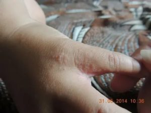 Сыпь между пальцами у ребенка