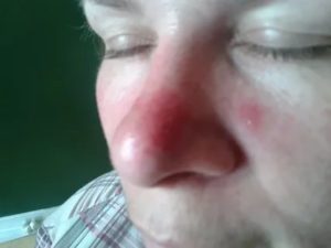 Красное пятно на носу