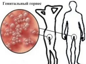 ЭКО при генитальном герпесе