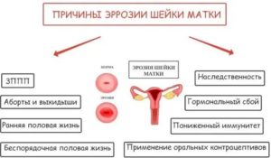 Лечение эрозии шейки матки и  бактериального вагинита