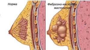 ЭКО при мастопатии