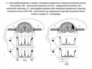 Как проводится Эхо-ЭС головного мозга?