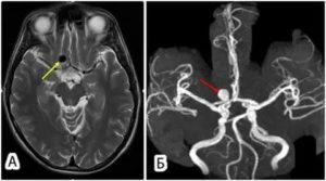 Почему МРТ не показало аневризму?