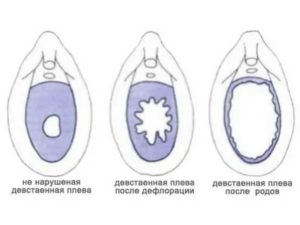 Можно ли порвать плеву с помощью струи воды?