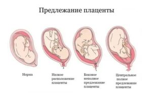 Опасно ли полное предлежание хориона на 13 недели беременности?