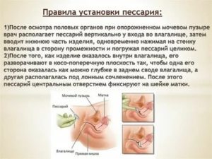 Можно ли вставлять пессарий при молочнице?