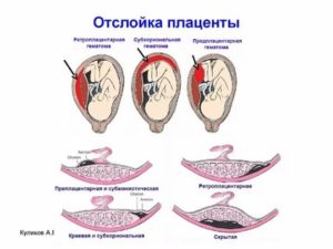 Какие лекарства назначают при отслойке плаценты?