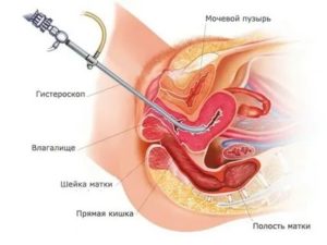 Комплекс вопросов по приему ОК после удаления полипа