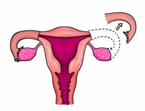 Кровотечение после удаления маточной трубы
