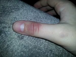 Желтое болезненное пятно на пальце