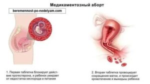 Задержка после аборта: вероятность беременности