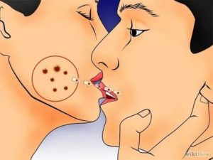 Возможно ли заразиться сифилисом при поцелуе?