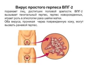 ЭКО при генитальном герпесе