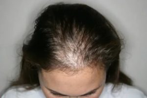 Запоры, выпадение волос