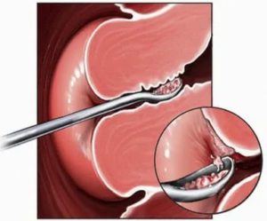 Месячные после удаления полипа эндометрия