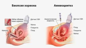 Что означает хорошая биопсия ворсин хориона?