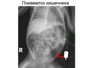 Что такое пневматоз кишечника?