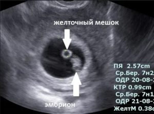 Если есть желтый мешочек, то эмбрион появится?