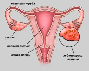 Может ли киста рассосаться при месячных?