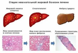 Поставили жировой гепатоз и липоматоз поджелудочной железы, какое лечение посоветуете?