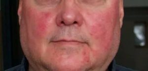 Может ли быть аллергия на Эутирокс?