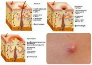 Прыщ при простуде, нагноение